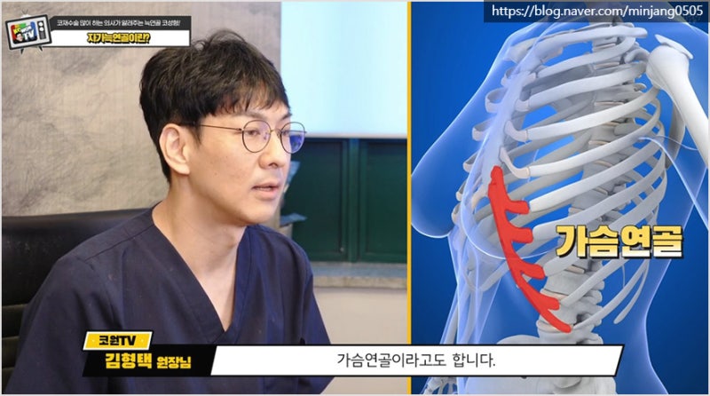 압구정코수술 유명한곳 자가늑연골 장점 및 단점 사진 10