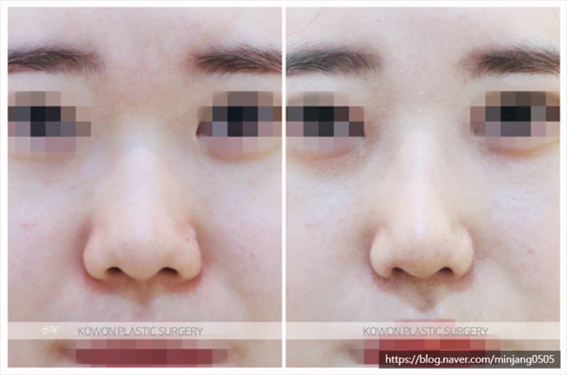 코성형술 하이코실 제거는 서울코재수술 병원에서 사진 6