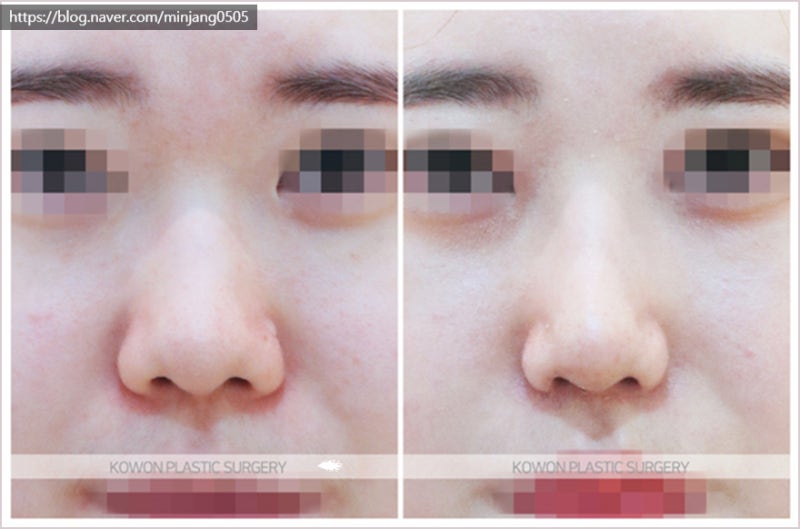 코끝높이기 및 코필러유지기간 압구정로데오성형외과 사진 6