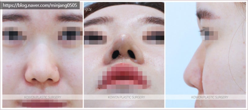 코끝높이기 및 코필러유지기간 압구정로데오성형외과 사진 4