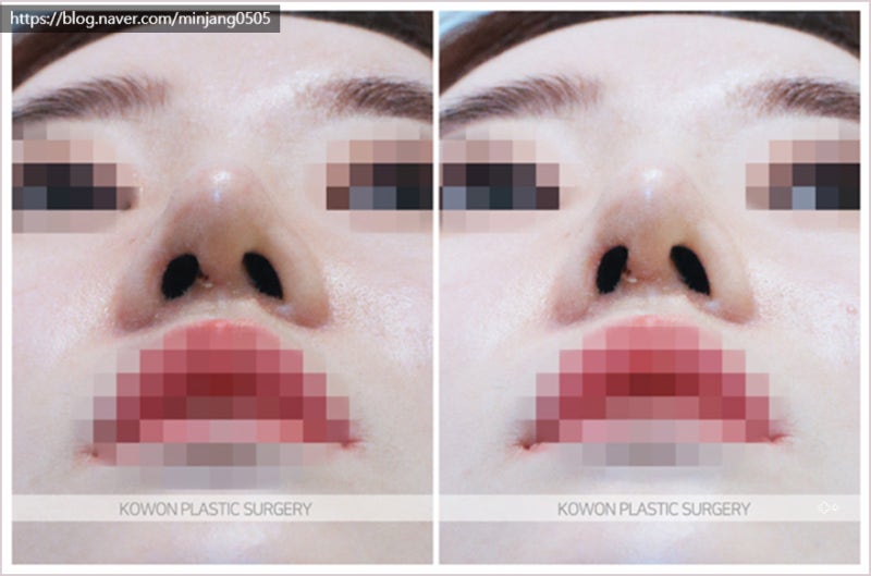 코끝높이기 및 코필러유지기간 압구정로데오성형외과 사진 8