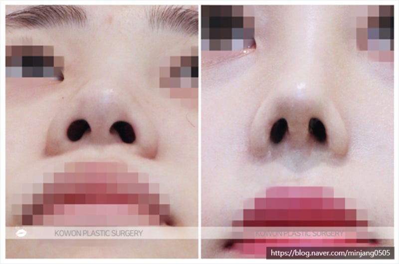 필러녹이는주사 후기 및 복코개선 가능한 압구정동성형외과 사진 6