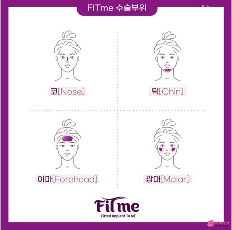 코성형 트렌트! 코원성형외과 3D 맞춤 보형물 핏미 도입 사진 8