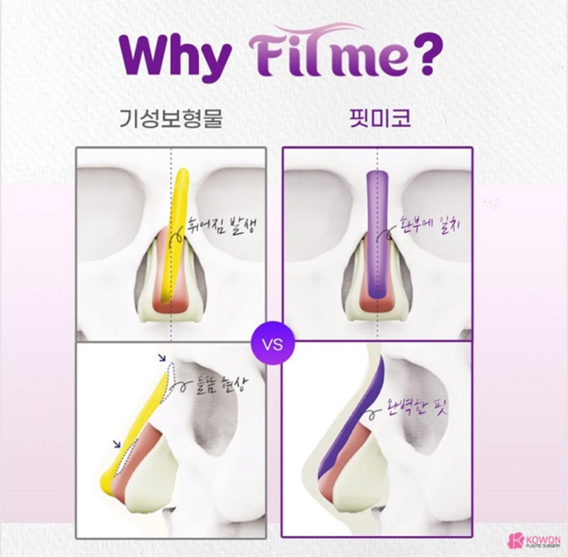 코성형 트렌트! 코원성형외과 3D 맞춤 보형물 핏미 도입 사진 11