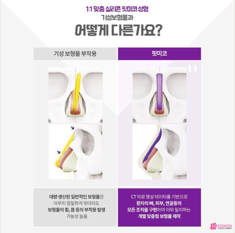 코성형 트렌트! 코원성형외과 3D 맞춤 보형물 핏미 도입 사진 3