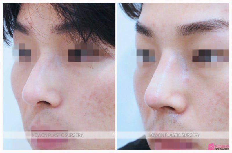 남자매부리코수술 및 30대남자성형 잘하는 논현동성형외과