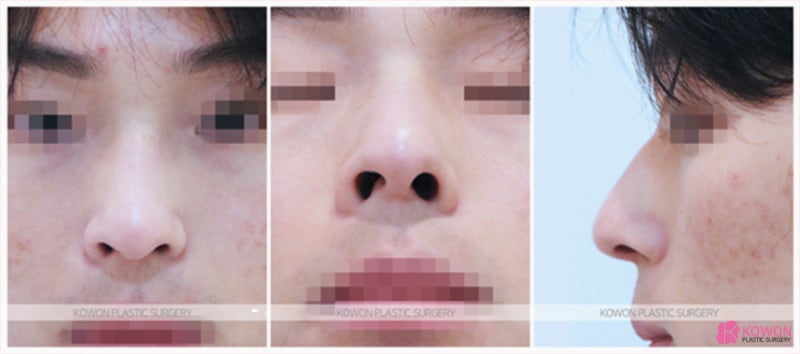 남자매부리코수술 및 30대남자성형 잘하는 논현동성형외과 사진 2