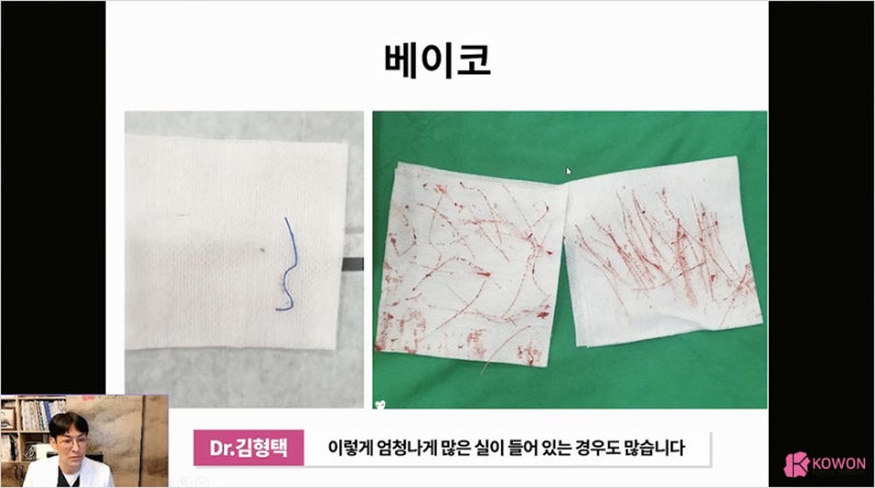 코실리프팅 부작용 및 콧대실 전체제거는 신논현성형외과 사진 7