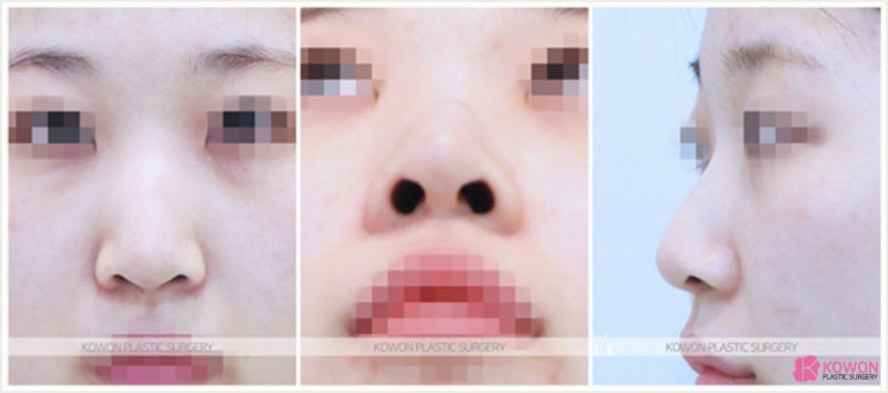 콧볼 작아지는법 및 코끝묶기 수술전후 사진 3