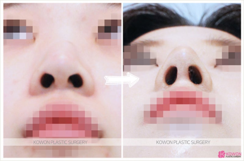 콧볼 작아지는법 및 코끝묶기 수술전후 사진 6