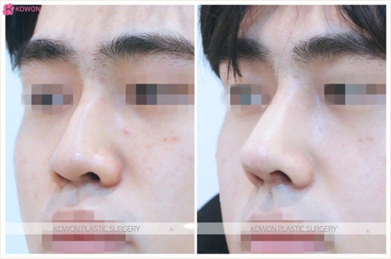매부리코관상 긍정적인 이미지로 변신한 남자코성형후기 사진 6