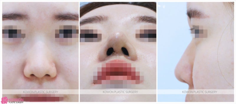 코끝올리기 및 코실제거는 안전한 코재수술잘하는곳 사진 2