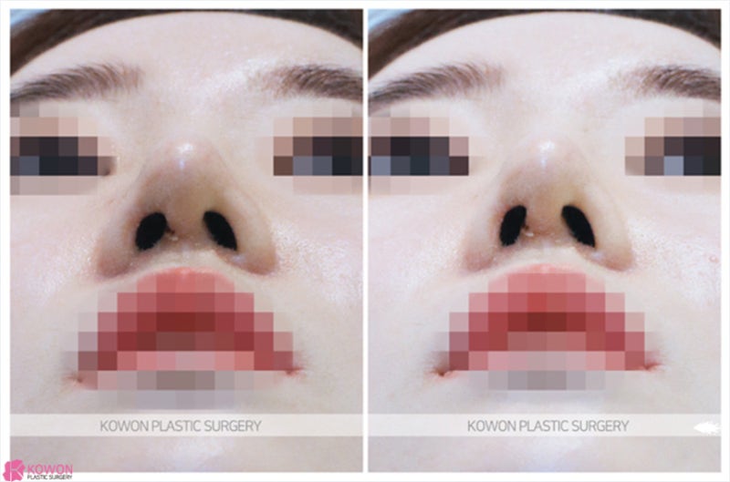 코끝올리기 및 코실제거는 안전한 코재수술잘하는곳 사진 8
