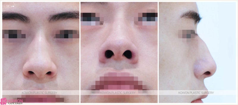 일자코 입체적인 이미지 남자코끝성형