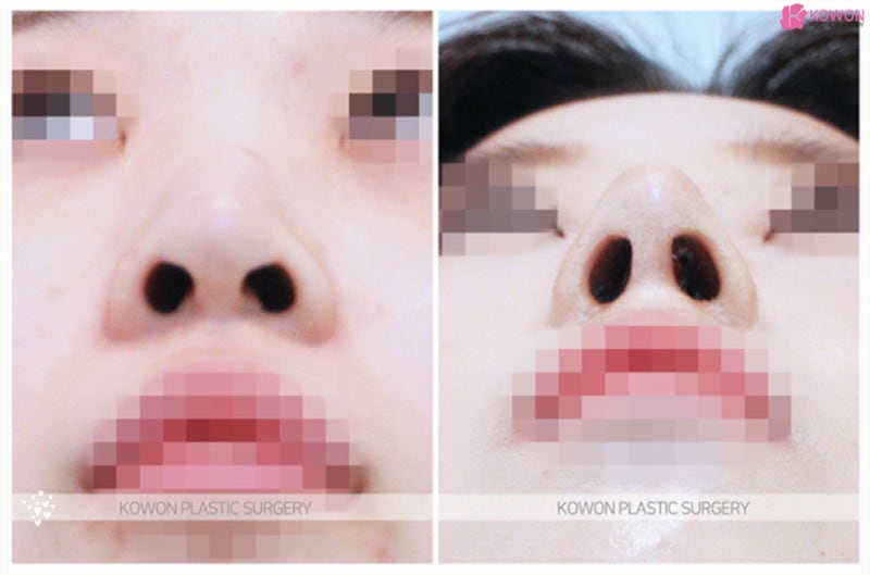 코연골묶기 노안이미지 개선과 세련된 코길이 사진 5
