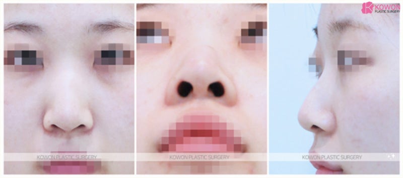 코연골묶기 노안이미지 개선과 세련된 코길이