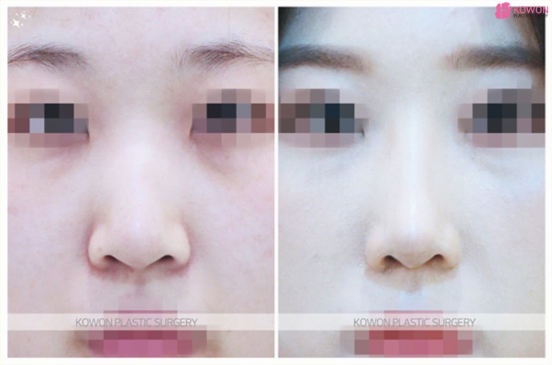 코연골묶기 노안이미지 개선과 세련된 코길이 사진 6