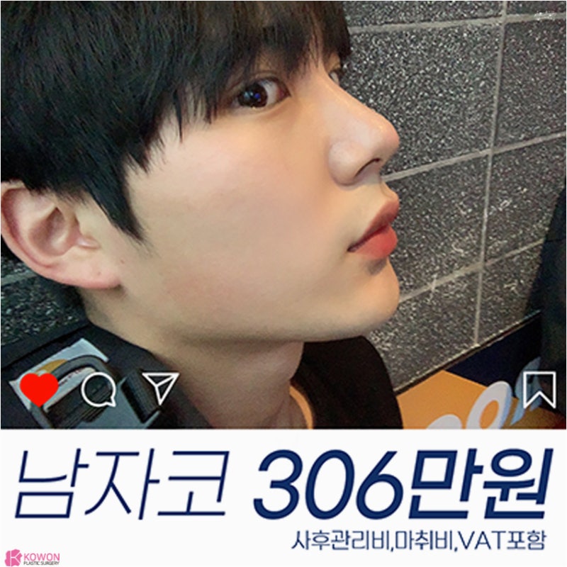[코원성형외과 이벤트] 남자코성형 할인이벤트 (직선코, 훈남이미지)