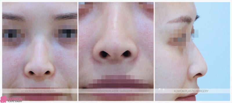 필러녹이기 진행 후 오똑한코 만드는 논현성형외과 사진 2