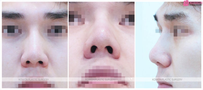 코끝성형 잘하는곳 코필러 제거 후 남자코재수술