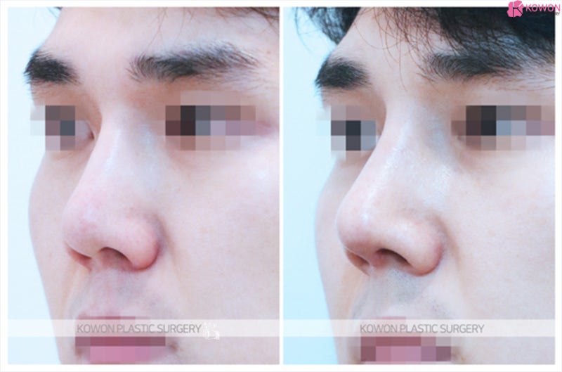 코끝성형 잘하는곳 코필러 제거 후 남자코재수술 사진 6