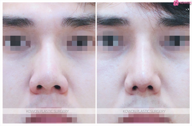 코끝성형 잘하는곳 코필러 제거 후 남자코재수술 사진 8
