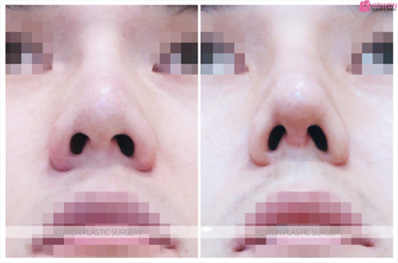코끝성형 잘하는곳 코필러 제거 후 남자코재수술 사진 7