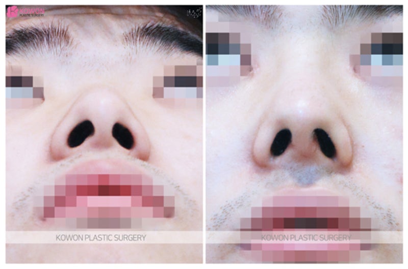 콧구멍작아지는법 비염 있는 휜코수술후기 사진 6