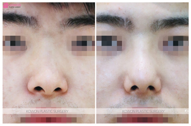 콧구멍작아지는법 비염 있는 휜코수술후기 사진 5