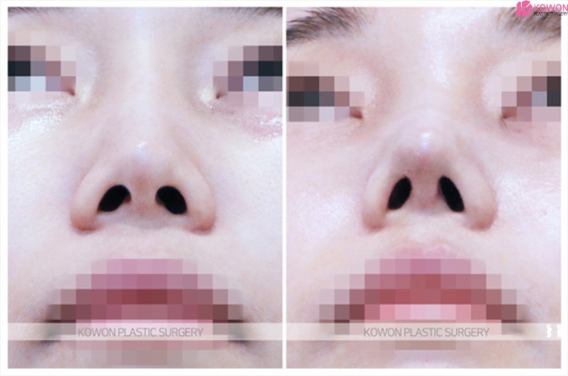콧대높아지는법 합리적인 코재수술비용 사진 7