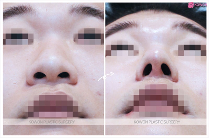 남자코 둔한 이미지 개선한 복코수술후기