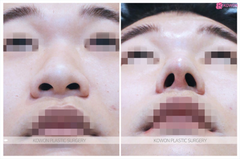 남자코 둔한 이미지 개선한 복코수술후기