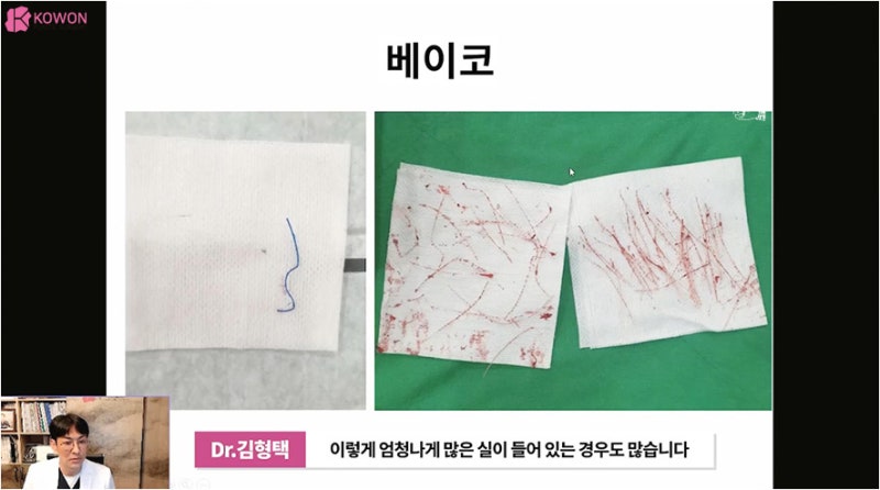 바비코 안전한 실제거는 코재수술성형외과 사진 7