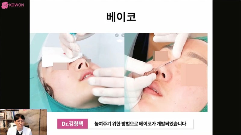 바비코 안전한 실제거는 코재수술성형외과 사진 4