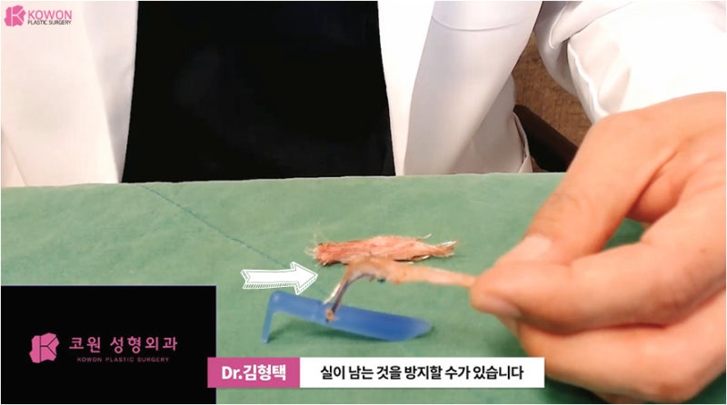 바비코 안전한 실제거는 코재수술성형외과 사진 11
