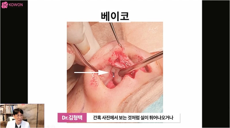 바비코 안전한 실제거는 코재수술성형외과 사진 5