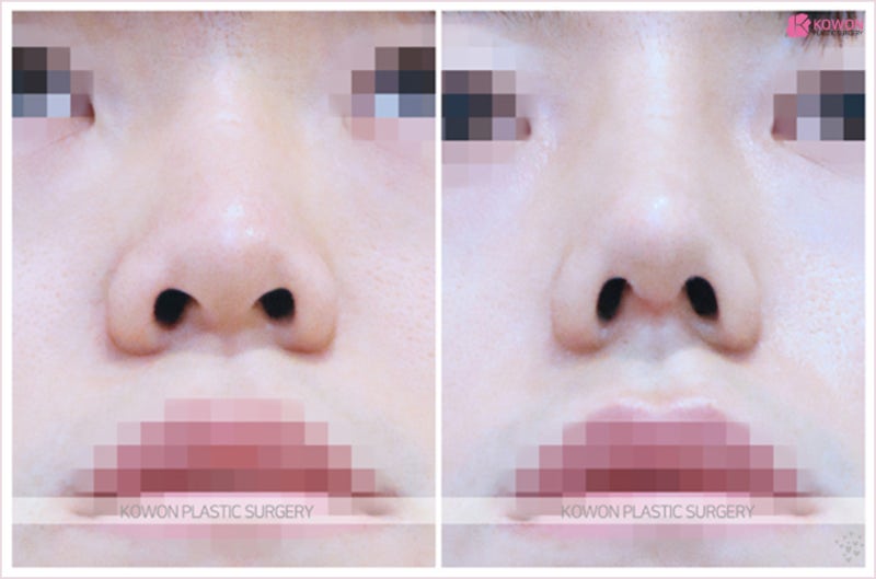 낮은코성형후기 코끝 살리는 비중격연장술 사진 5