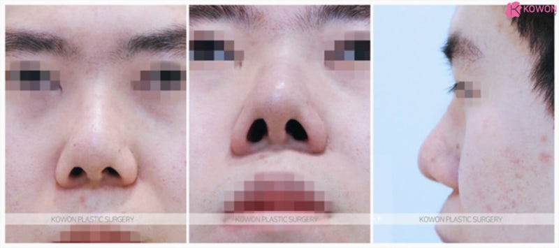 비순각 개선을 위한 뭉뚝한코 수술 성공후기