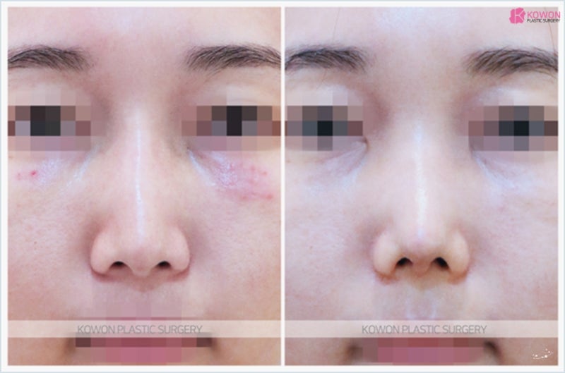 미스코 제거 후 압구정코재수술 잘하는곳 사진 8