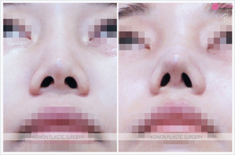미스코 제거 후 압구정코재수술 잘하는곳 사진 7