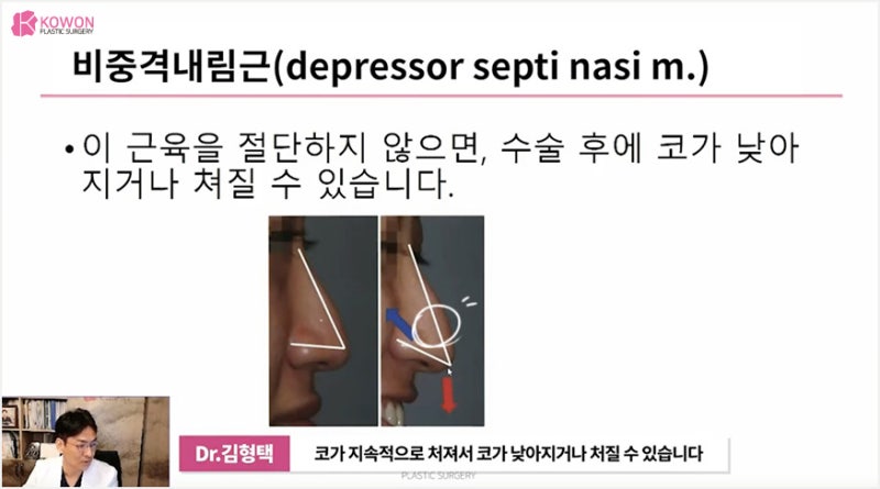 강남성형외과유명한곳 밸런스 맞춘 화살코교정 사진 11