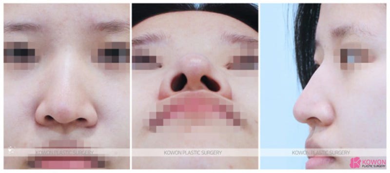 코끝처짐 비대칭교정 잘하는곳 신사역1번출구성형외과
