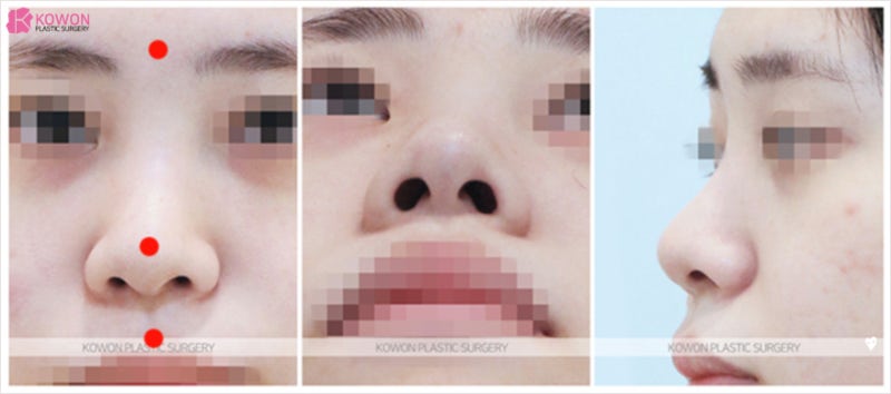 논현역성형외과 코필러녹이는주사 맞고 예쁜코수술