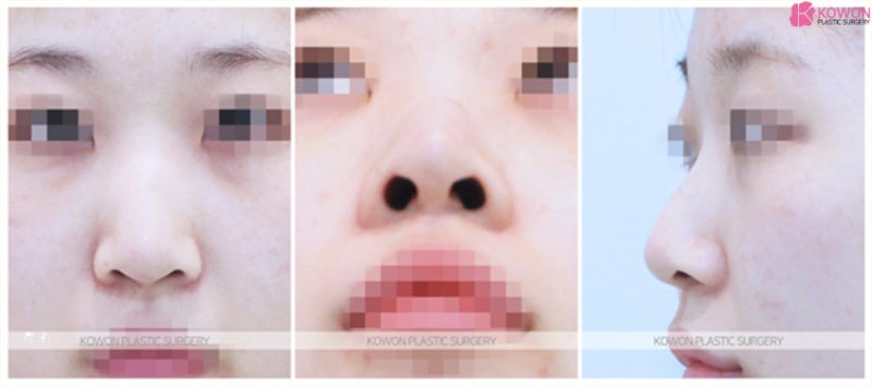 코성형잘하는곳 흉터 걱정 없는 켈로이드성형