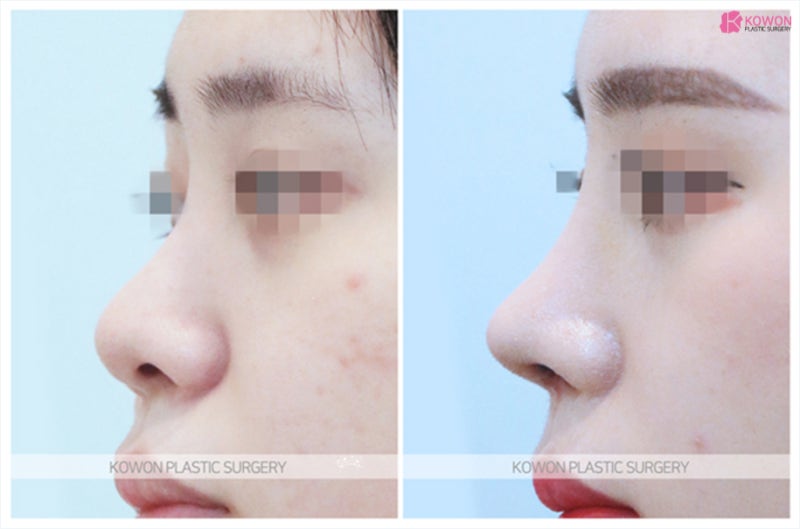 코재수술잘하는병원 실력있는 코재건 전후 사진 8