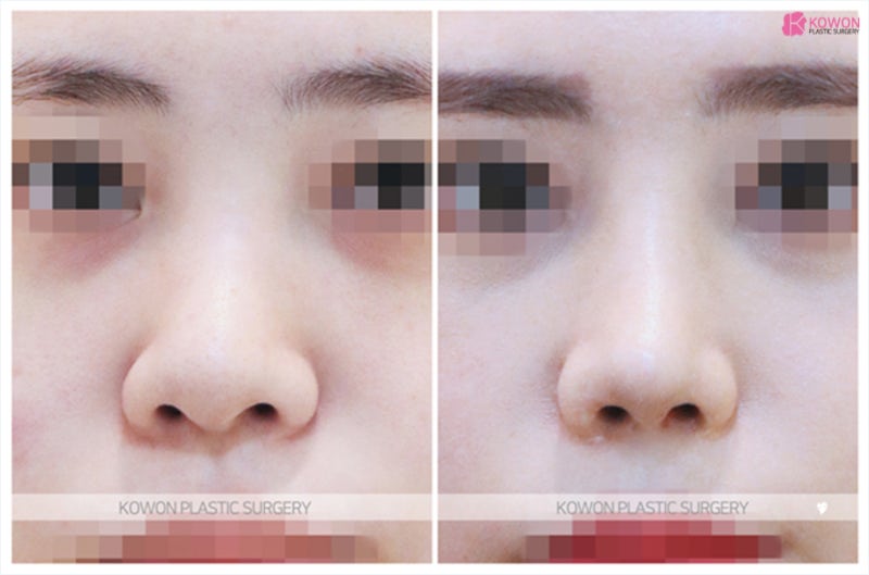 코재수술잘하는병원 실력있는 코재건 전후 사진 6