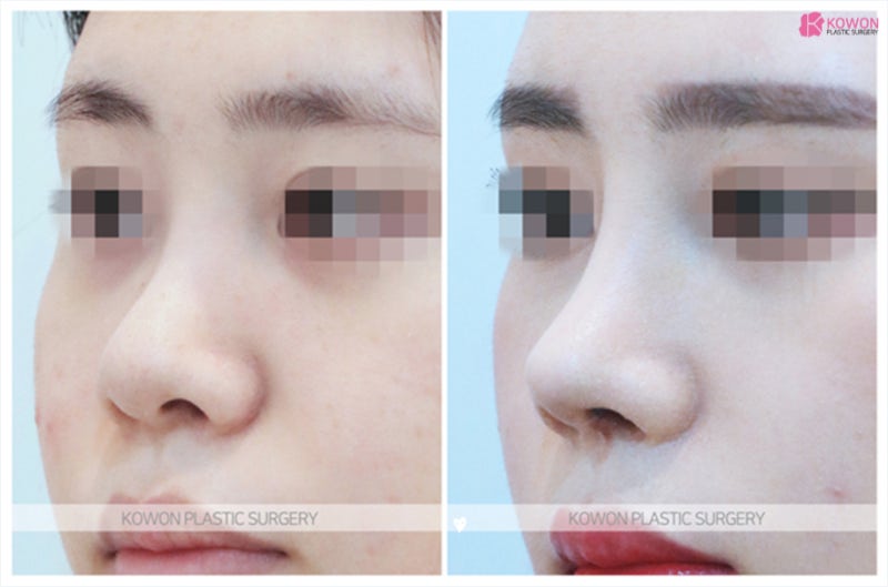 코재수술잘하는병원 실력있는 코재건 전후 사진 5