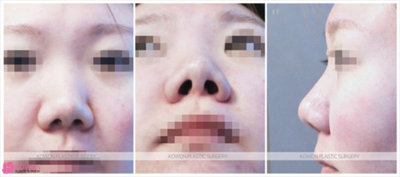 신논현역성형외과 확연히 다른 콧볼작아지는법