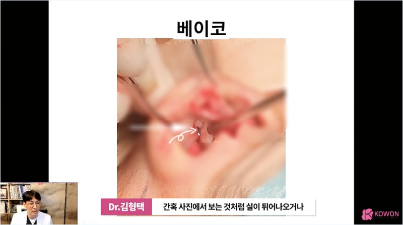 코재수술시기 부작용 최소화하는 코실 제거 병원 사진 5