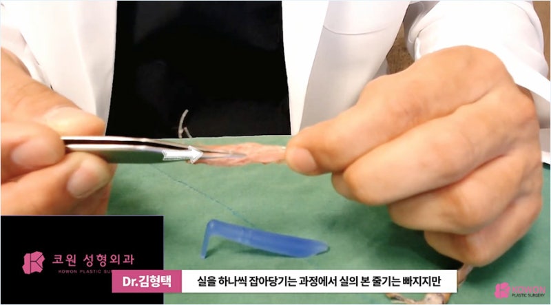 코재수술시기 부작용 최소화하는 코실 제거 병원 사진 12